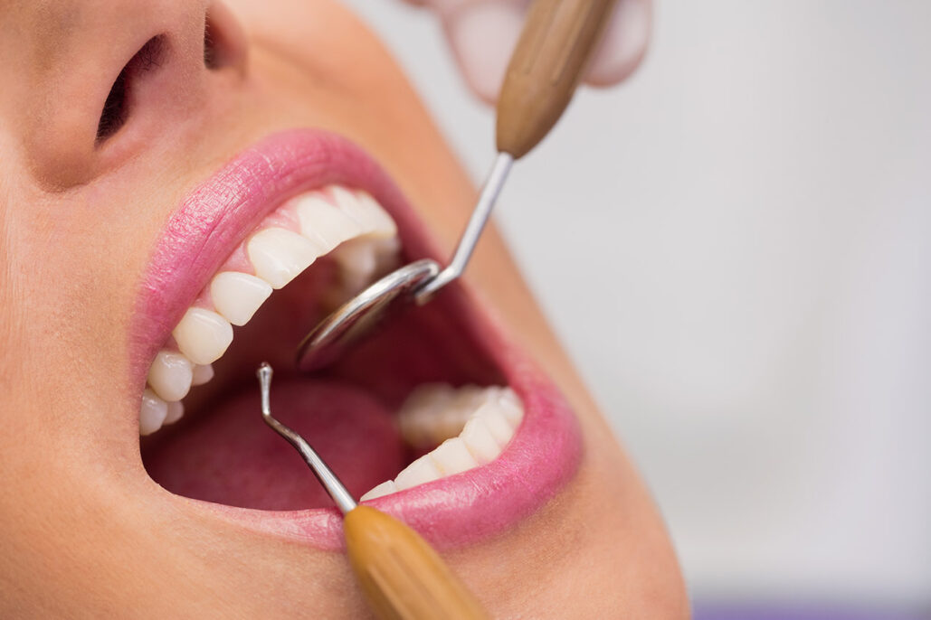 Diş Taşı Temizliği Neden Yapılmalıdır?