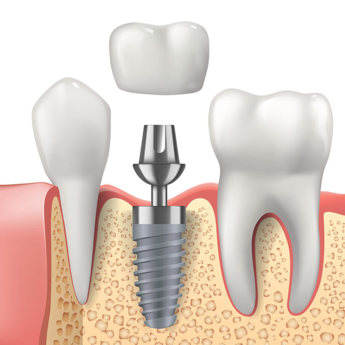 Her hastaya implant uygulanır mı?